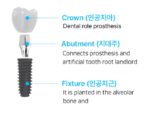 CORE1 Implant