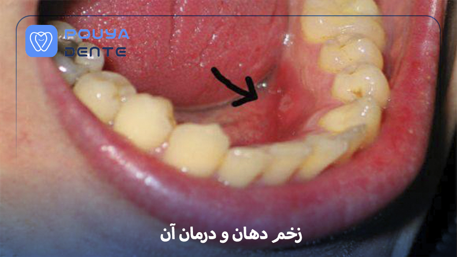 Mouth ulcers