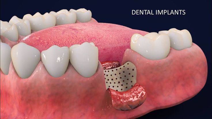 Bone grafting