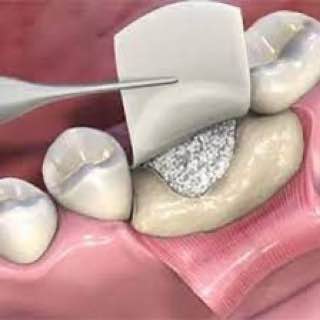 Bone grafting