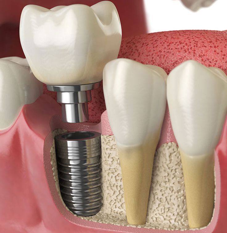 Bone grafting