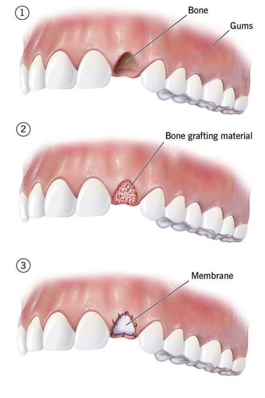 Bone grafting1