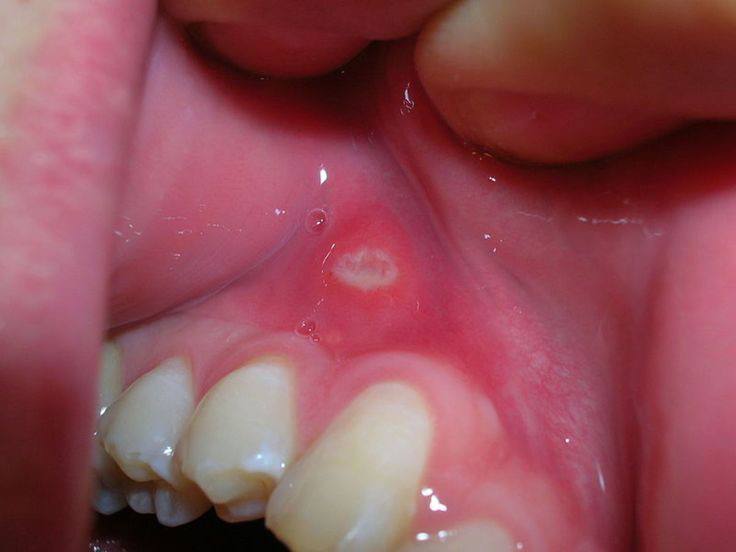 Mouth ulcers