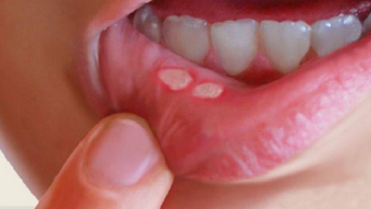 Mouth ulcers