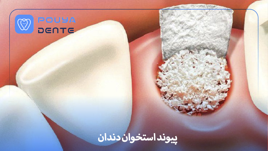 Bone grafting