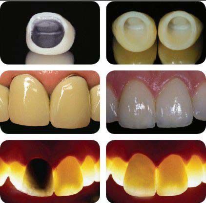 PFM repair1