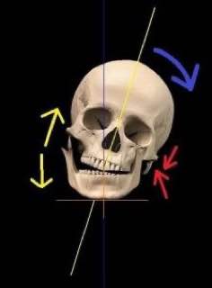 Osteolysis of the jaw1