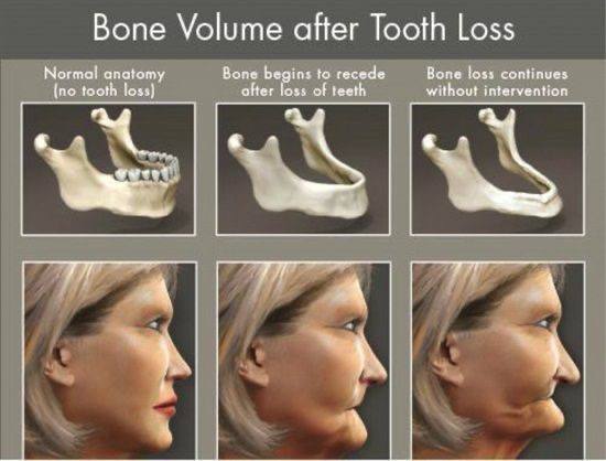 Osteolysis of the jaw4