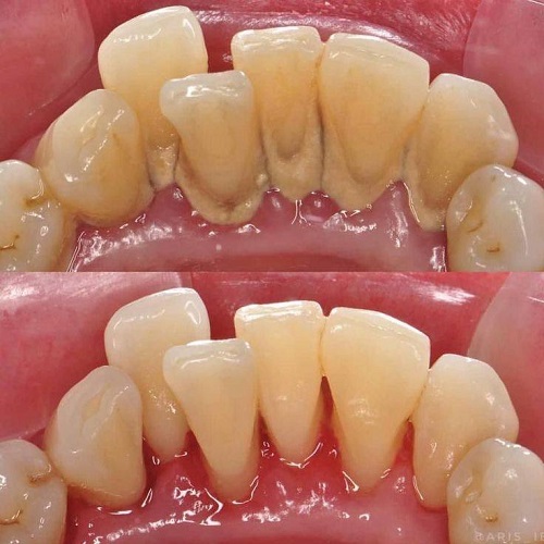 dental plaque1