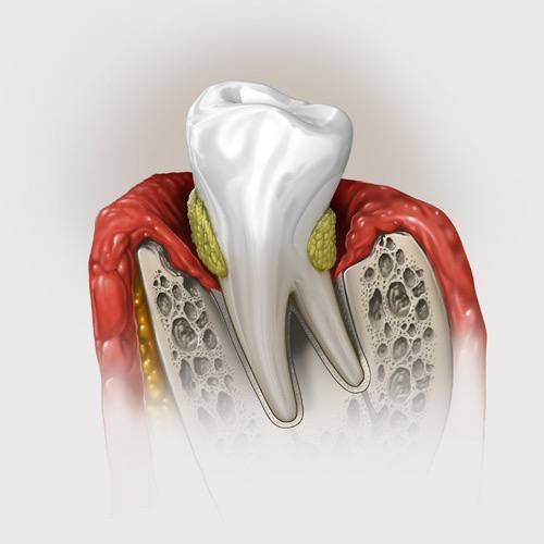 dental plaque2