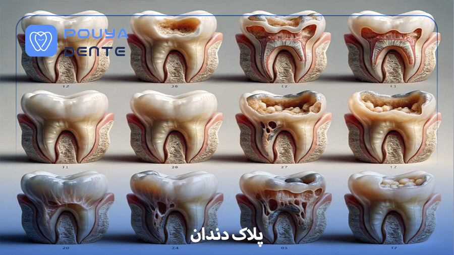 dental plaque