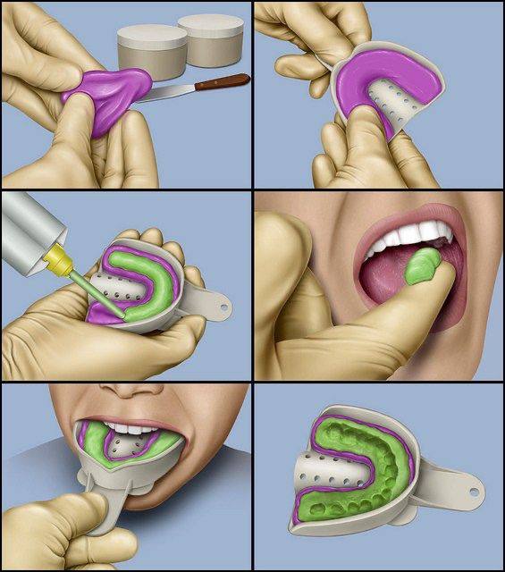 Dental molding materials3