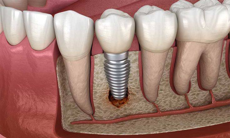 artificial teeth2