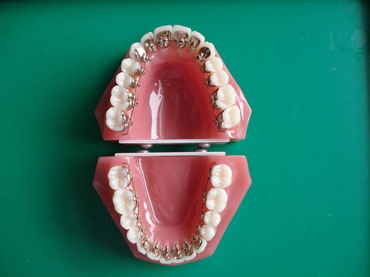 Method of performing orthodontics3