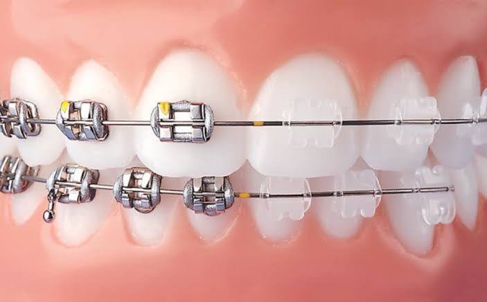 Method of performing orthodontics2