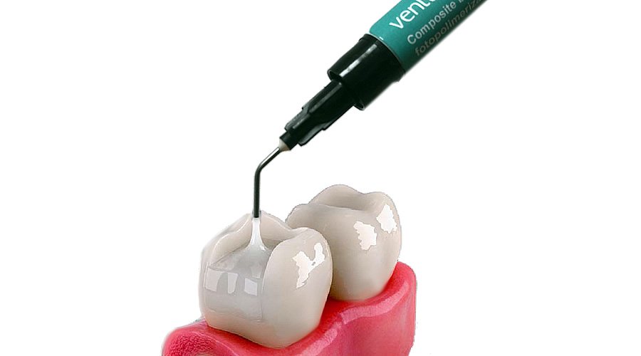 Dental composite2