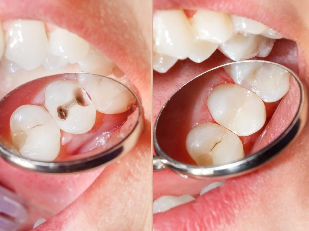 Dental composite3