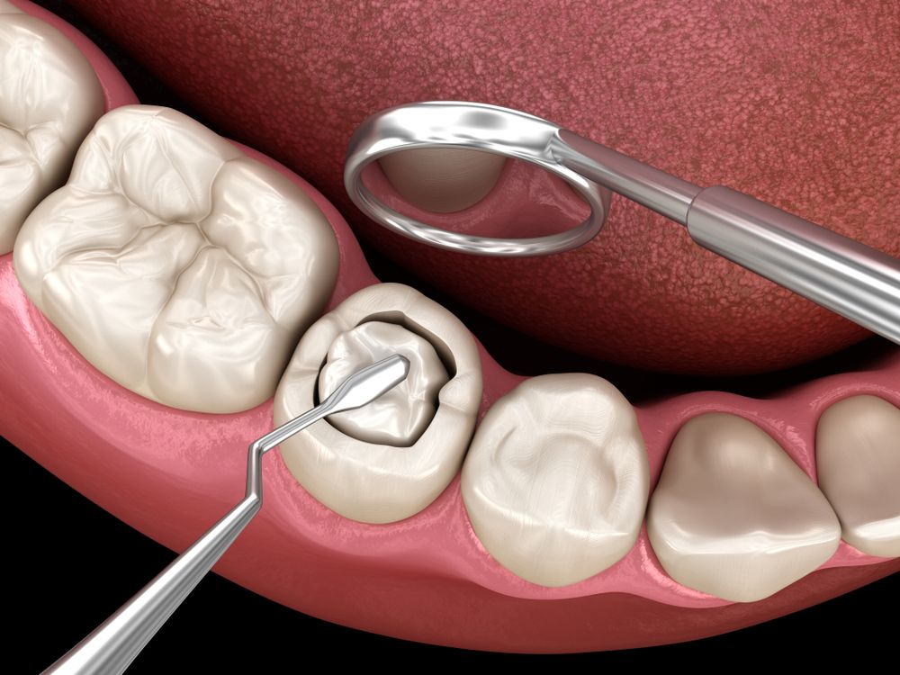 Dental composite4