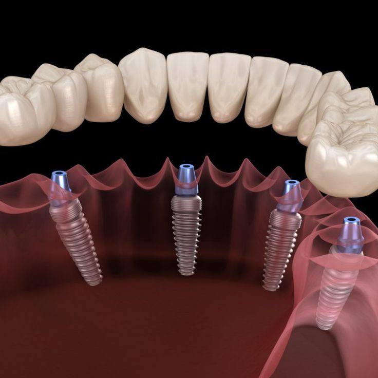 Comparison of implant brands1