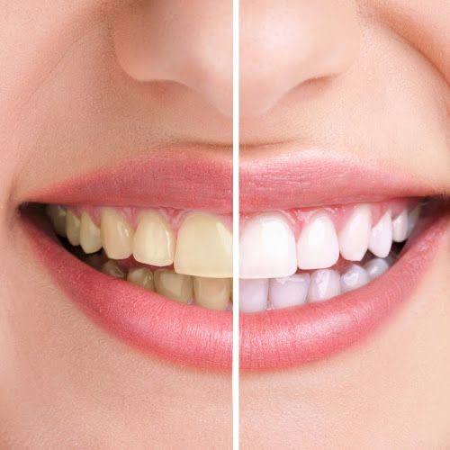 Teeth bleaching2