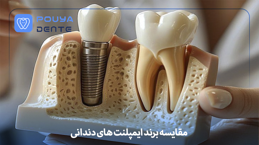 Comparison of implant brands