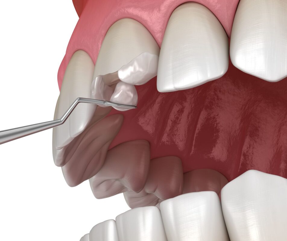 Dental composite1