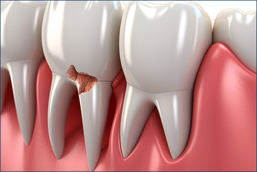 Dental Restoration