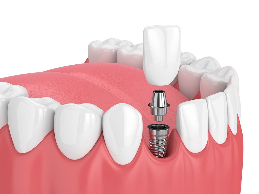 Implant fixture