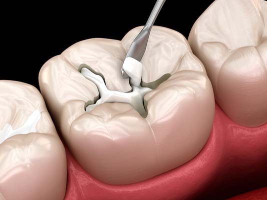 Dental Restoration