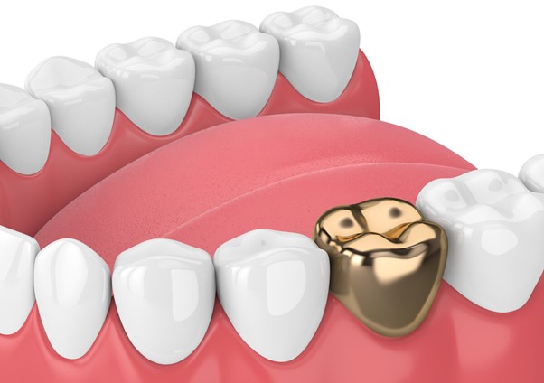 Dental Restoration