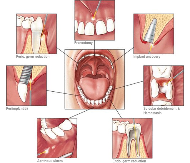 Dental laser