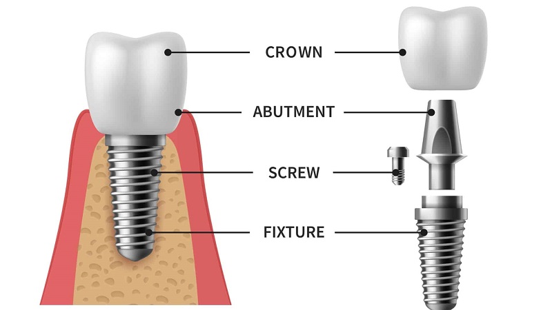 Implant fixture