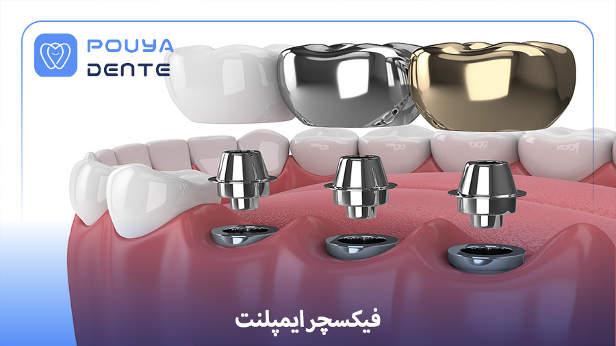 Implant fixture