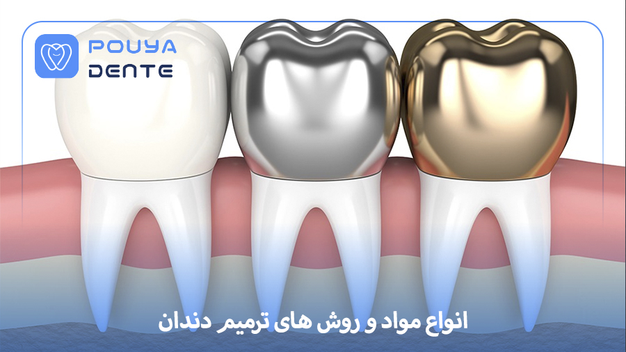 Dental Restoration