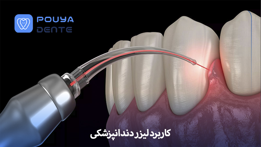 Dental laser