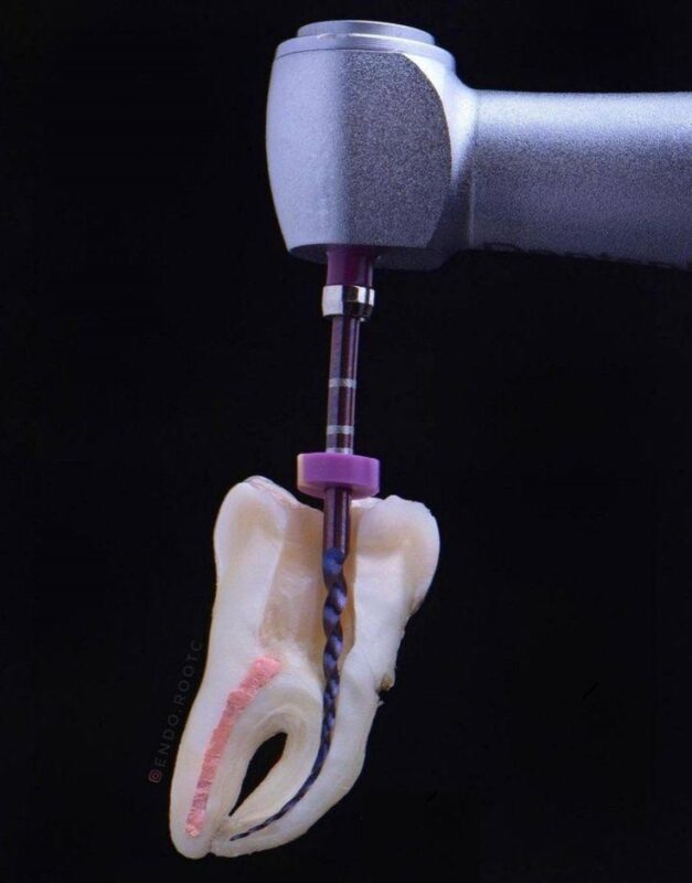 Root canal treatment