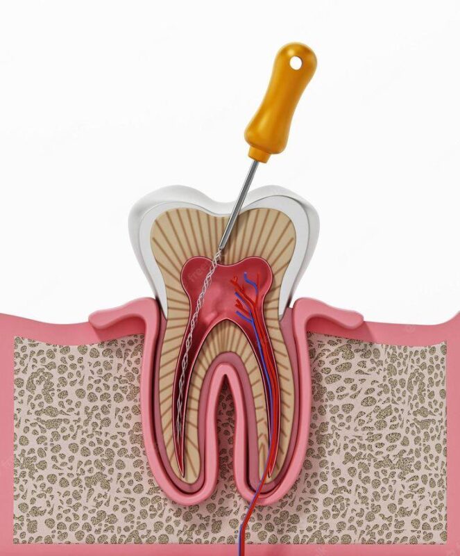 Root canal treatment