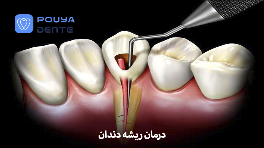 Root canal treatment