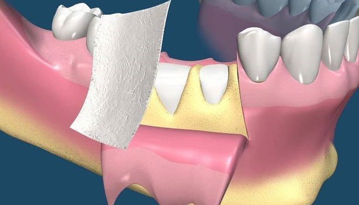 Periodontal surgery