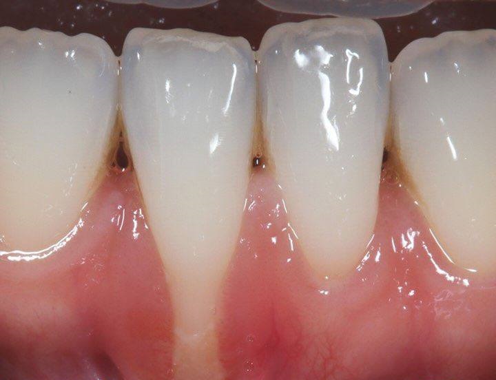 Periodontal surgery