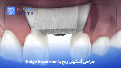 ridge-expansion