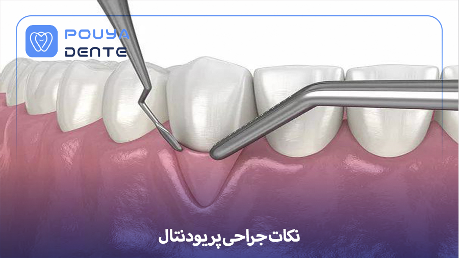 Periodontal surgery