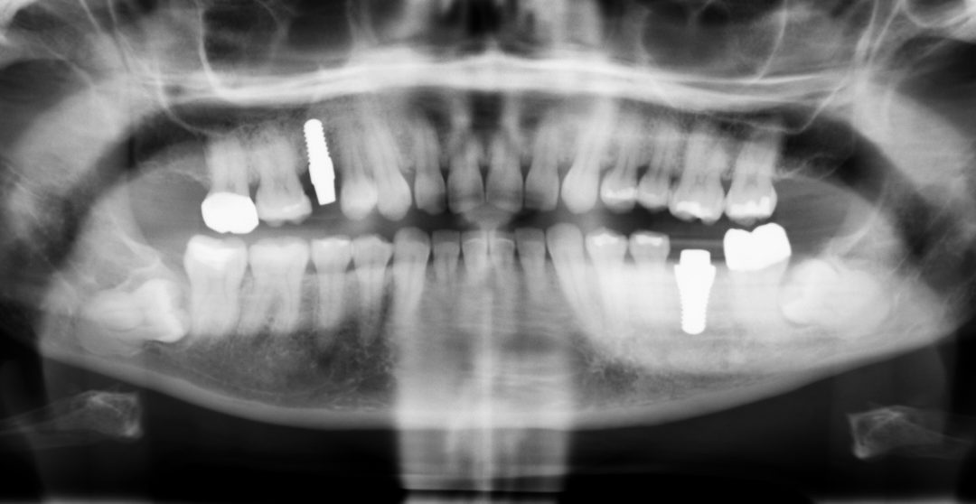 Trigeminal nerve and implants