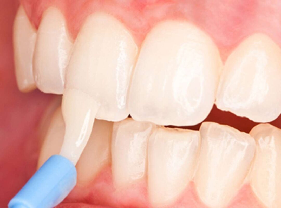 Fluoride therapy
