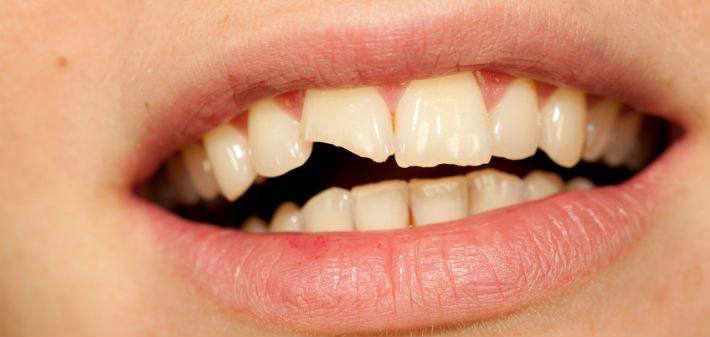 Tooth fracture