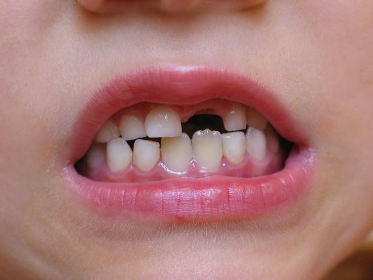 Tooth fracture