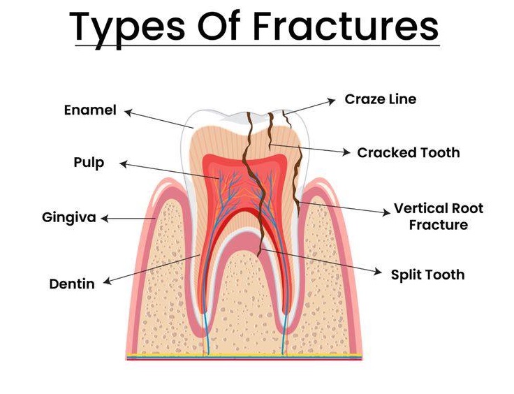 Tooth fracture