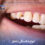 Tooth fracture