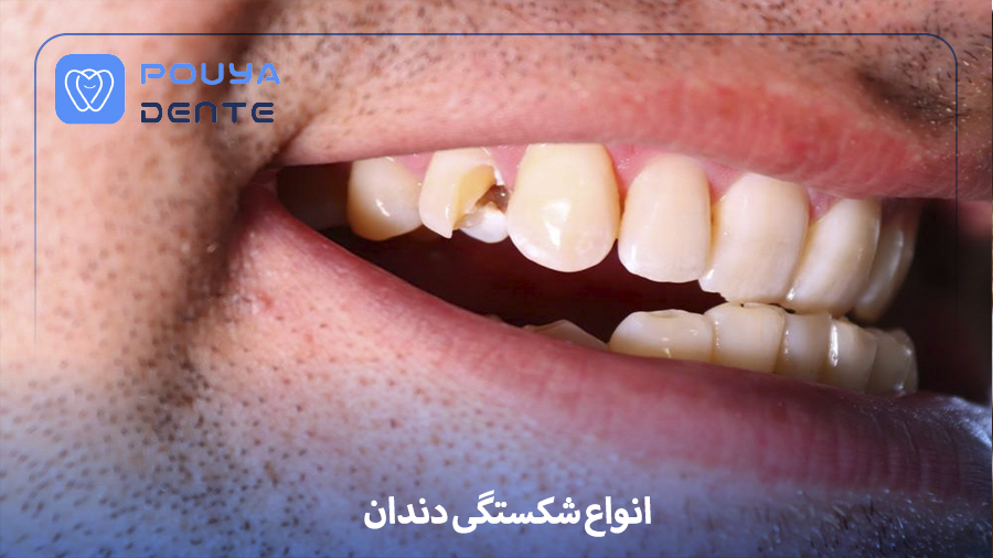 Tooth fracture