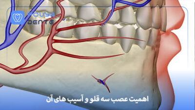 Trigeminal nerve and implants